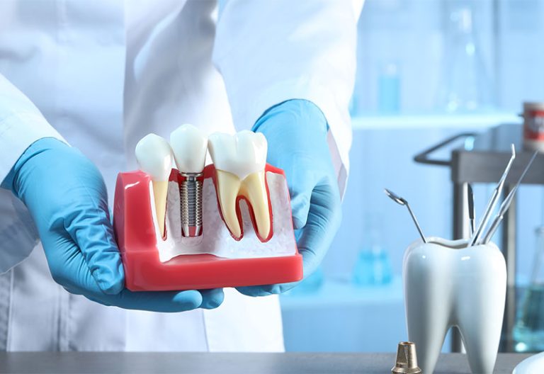 Central Dental Family - Dentist holding a dental implant diagram