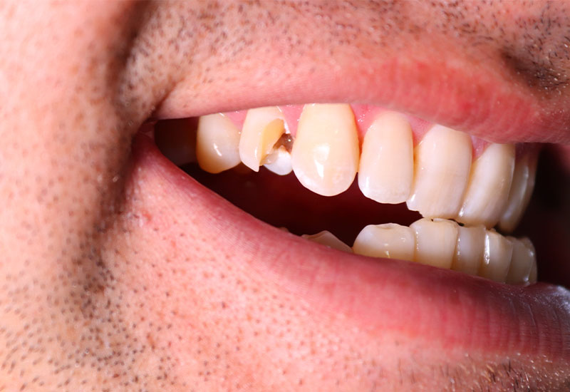 Central Dental Family - Dentist looking at a chipped tooth