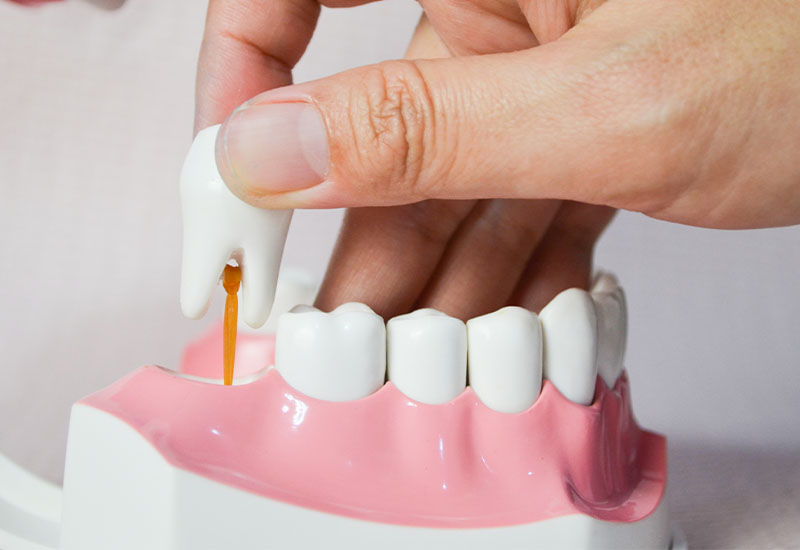 Central Dental Family - Dentist holding a dental implant diagram